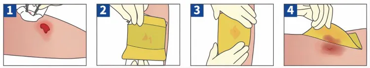 hydrocolloid with adhesive hydrocolloid with adhesive